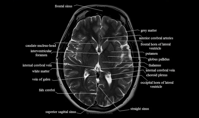 Brain MRI Object Detection